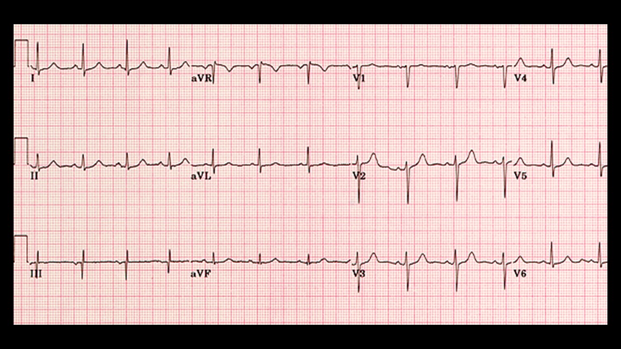 12 Lead ECG Interpretation