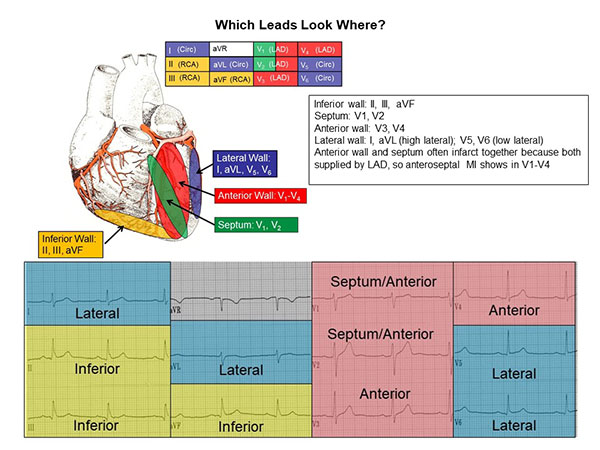 difference between lead 1 and lead 2 ecg placement