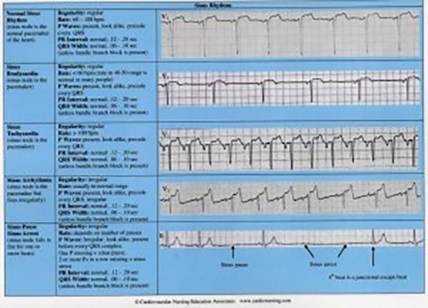 Cardiac Arrhythmia Chart