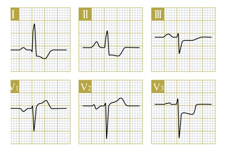 12 Lead ECG Interpretation: Essential Skills for Clinical Practice (For Nurses)