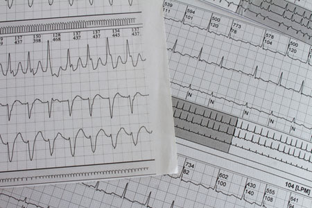 Free Cardiac Arrhythmia Reference Chart