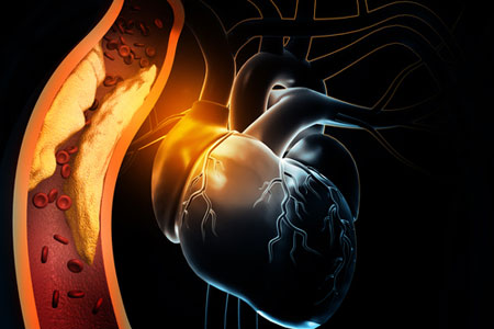 Acute Coronary Syndrome and Vascular Disease
