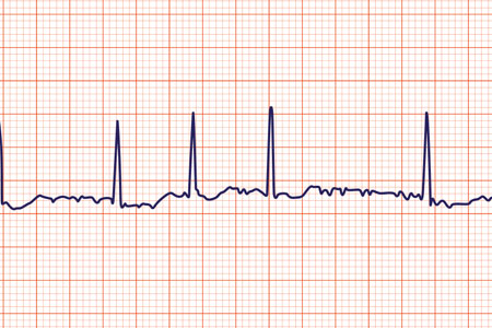 Atrial Arrhythmias