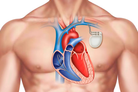 Pacemakers and Implantable Cardioverter Defibrillators