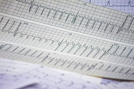 Supraventricular Tachycardias