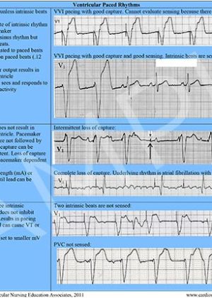 Cardiac Arrhythmia Reference Chart