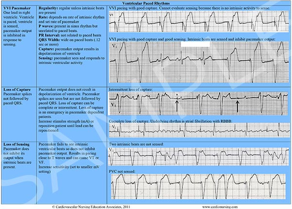 Cardiac Arrhythmia Reference Chart